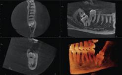 uzyskania obrazu całego łuku zębowego: Planowanie wielu implantów w jednej