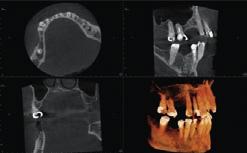 oraz fragmentów zatoki szczękowej: Planowanie wielu implantów w obu szczękach