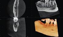 wszczepienia implantu czy obrazowanie RTG u dzieci. 5 x Ø5 cm obraz 3D z DRT. Dawka promieniowania* 1 5 2D 3D 8 x Ø15 cm 3D obraz panoramiczny z DRT.