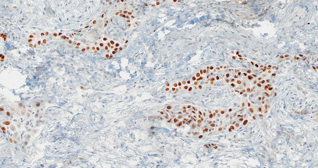 Rycina 3. Badanie immunohistochemiczne: TTF-1.