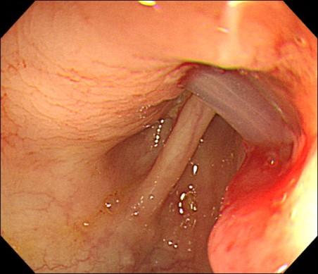 Uncommon Complication during Percutaneous Endoscopic Gastrostomy