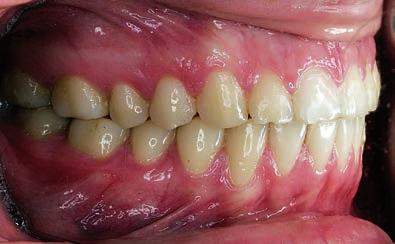 patologicznych ze strony stawów skroniowo żuchwowych. W badaniu periodontologicznym nie stwierdzono odchyleń od normy.