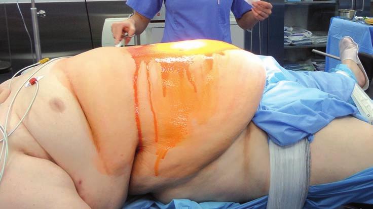 Ryc. 1. 18-letni pacjent o wadze 224 kg operowany w Klinice Chirurgii Mazan (wykonano mankietową resekcję żołądka).