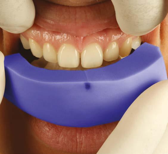 Acrytemp As simple as a