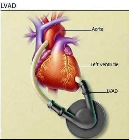 Wstrząs kardiogenny -ostra niewydolność układu krążenia Mechaniczne wspomaganie pracy serca VAD - ventricular assist device IVAD - implantable ventricular assist device TAH - total assist device LVAD