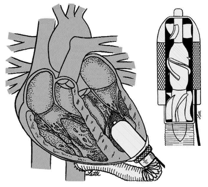 MicroMed/DeBakey (MM-D VAD) Jarvik 2000 Heart Pompa osiowa