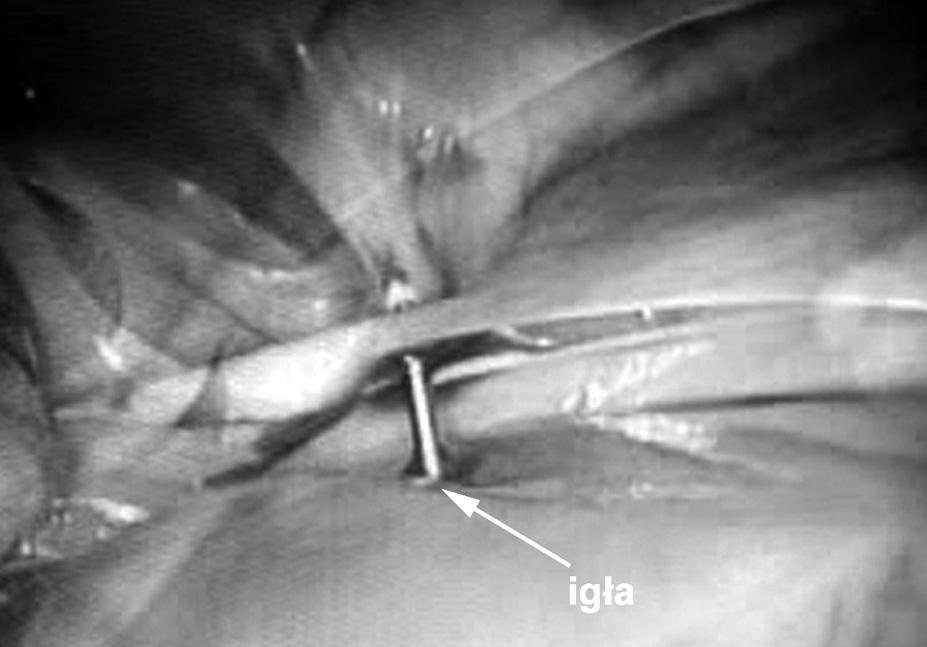 Folia Cardiol. 2005, tom 12, nr 12 Rycina 2. Uwidocznienie igły nakłuwającej serce w badaniu torakoskopowym Figure 2. The needle puncturing heart wall visible in thoracoscopy Rycina 4.