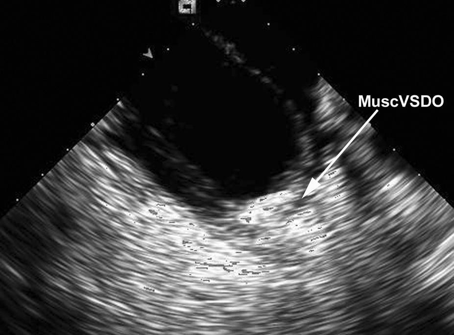 Muscular VSDO inserted in the heart wall under the papillary muscle visualized with AcuNav transducer W wewnątrzsercowym badaniu echokardiograficznym z użyciem sondy AcuNav nie obserwowano zaburzenia