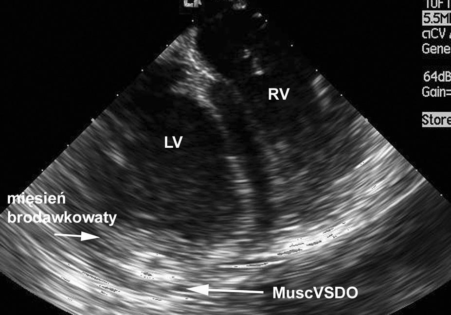 Badanie wewnątrzsercowe wykonane sondą IVUS (Boston Scientific) podczas zabiegów dostarczało mniej informacji w czasie implantacji Muscular VSDO, ponieważ nie uwidaczniało kompleksowej anatomii serca