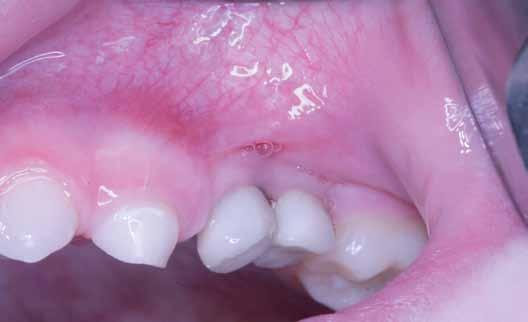 _terapie interdyscyplinarne _magazine Ryc. 16_zdjęcie wewnątrzustne, odbudowa protetyczna na implantach j/w 3222. Ryc. 16 nia, postanowiono o rozłożeniu implantacji na kilka etapów.
