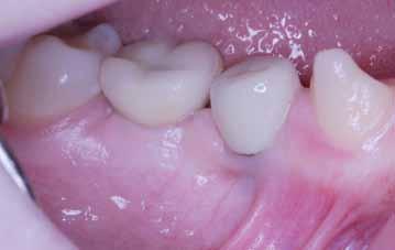 _magazine _terapie interdyscyplinarne Ryc. 17 Ryc. 18 Ryc. 19 Ryc. 20 Ryc. 17_Odbudowa protetyczna na implantach, strona prawa żuchwy. Ryc. 18_Obraz dziąsła: estetyka biało-różowa w szczęce po stronie lewej.