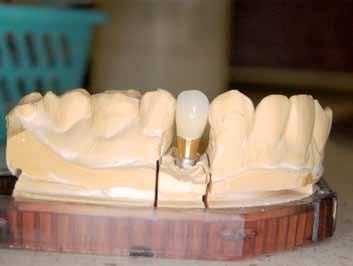 _estetyka Wykonanie i zastosowanie prac z kompozytów technicznych na implantach stomatologicznych Performing and application of dental over structures made from laboratory composites Autorzy_ Łukasz
