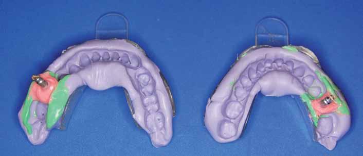 7_Most 3-punktowy adhezyjnie połączony z łącznikami do prac cementowanych na implantach Dentium w pozycjach 15 i 17 praca po osadzeniu w jamie ustnej,