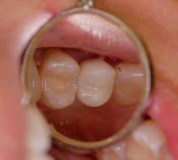 Korona kompozytowa adhezyjnie połączona z łącznikiem do prac cementowanych Dentium. Brak szczelin i jednorodna konstrukcja pracy sprzyja zachowaniu dobrej higieny.