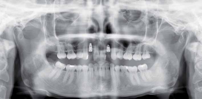 _estetyka Ryc. 2_Preparacja łoża pod implant ImmediateLoad 3,4 mm x 10 mm. Pomocne jest rozciągnięcie nitki dentystycznej pomiędzy kłem a siekaczem centralnym.
