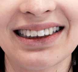 : The genetics of human tooth agenesis: new discoveries for understanding dental anomalies. Am J. Orthod. Dentofacial Orthop., 2000, 117, 6, 650-656. 3. Zadurska M.