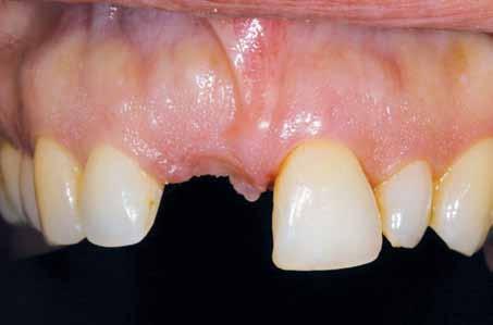 _estetyka Implantacja i jednoczasowy przeszczep tkanek miękkich w miejscu górnego siekacza centralnego Implant placement and simultaneous soft-tissue grafting of a maxillary central incisor Autor_