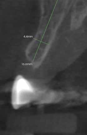 Badania wykazały wystarczającą ilość kości na wszczepienie implantu i niedobór tkanek miękkich w wymiarze poziomym.