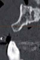 _CBCT in diagnosis Small-diameter for single anterior restorations Author_ Dr Richard Marcelat, France _Case 1: Small