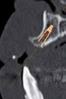In order to avoid bone grafts, we use narrow with satisfactory results.