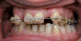We worked in close collaboration with an orthodontist colleague, Dr Frédéric Chalas, who took responsibility for adapting the