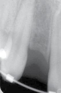 _CBCT in diagnosis regions #12 and 22, while aligning the apices of the adjacent teeth.
