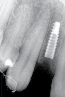 placed without the use of a bone augmentation technique. The cortical bone, however, was preserved (Figs. 3a 4). Narrow (Axiom 2.8, Anthogyr) were used for this restoration. Axiom 2.