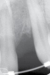 The special feature of the system is that the abutment is impacted without a transfixation screw. Abutments are available in several gingival heights and angulations, making Axiom 2.