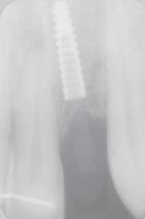 8 mm x 10 mm were placed 0.5 mm sub-crestally (Figs. 5a d). Very light drilling enabled bone condensation of the specific sites.