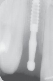 Temporary crowns were attached to the orthodontic arch wire and left in place for the three months of osseointegration in order to ensure post-orthodontic fixation of the teeth.