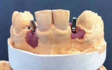 The insertion axis was visualized on the 3-D reconstruction of the CT scan cross-sections using SIMPLANT software (DENTS PLY).