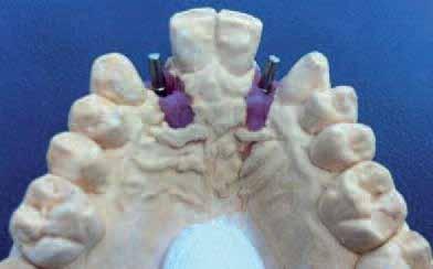 8 mm in diameter (Axiom 2.8), without which it would have been necessary to resume orthodontic treatment in order to align the apices of the adjacent teeth.