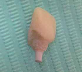 _Cases 3 and 4: Small antero-posterior volume Case 3 A 25-year-old female patient at the end of orthodontic treatment presented with unilateral agenesis at region #22.