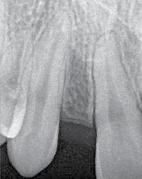 The periodontal condition of the surrounding teeth was stable, but the