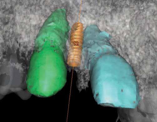implant-supported prostheses in cases in which there is a small mesiodistal