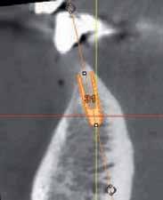 _CBCT in diagnosis Figs. 19 & 20_Implant planning at the end of orthodontic treatment. Fig. 21a_The 2.8 mm x 12 mm implant. Fig. 21b_Appearance 18 months after placement of the prosthesis and after gingival maturation.
