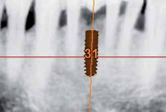 21b Small space, proximity to the apices of the adjacent teeth and small bone volume present surgical difficulties in the ideal positioning of.