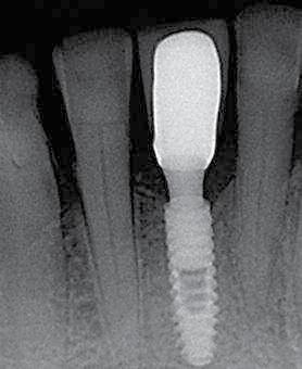 The large choice of abutments, in terms of gingival height and angulation, makes it possible to adapt to any clinical situation. _Conclusion Figs.