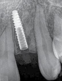 _about the author allowed us to avoid bone augmentation by guided bone regeneration or an onlay graft techniques that can be restrictive for patients