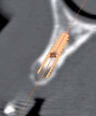 fr cone beam Although we do not have the clinical retrospection to offer our opinion on the strength and long-term durability of with small diameters