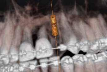The use of narrow for the management of single anterior restorations, especially for the replacement of mandibular incisors and maxillary lateral