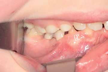 8_Żuchwa: odbudowa tymczasowa kompozytem na implantach, strona prawa. Ryc.