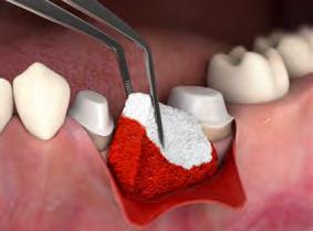 1 Zwiększenie objętości tkanek wokół implantu 2 Augmentacja tkanek w obrębie wyrostka 3 Alternatywa dla przeszczepów łącznotkankowych alternatywa dla przeszczepów autogennych Matryca Geistlich