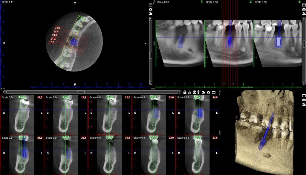 Implantát 4 pohledy: Axiální Panoramatický průřez řezu 3D model nástroje pro implantát přidání