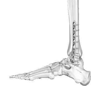 Płytka do kości strzałkowej dalsza boczna Distal lateral