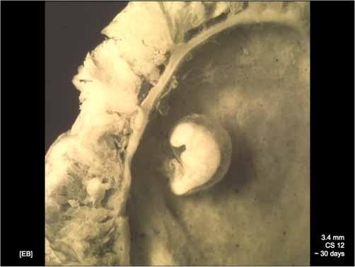 3.4 mm + chorionic sac [EB] 3.