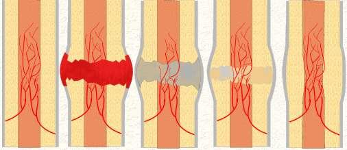Gojenie złamania Pierwotny, naczyniopochodny zrost kostny (Lane, Danis bezpośrednie wrastanie naczyń krwionośnych z ich progenitorów mesenchymalnych) max.