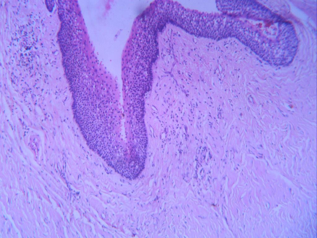 Dent Med Probl. 2018;55(4):447 451 449 wall was also noticed. Thus, the final diagnosis was OKC. The patient had been followed up for the subsequent 6months at the time of this report. Fig. 3.