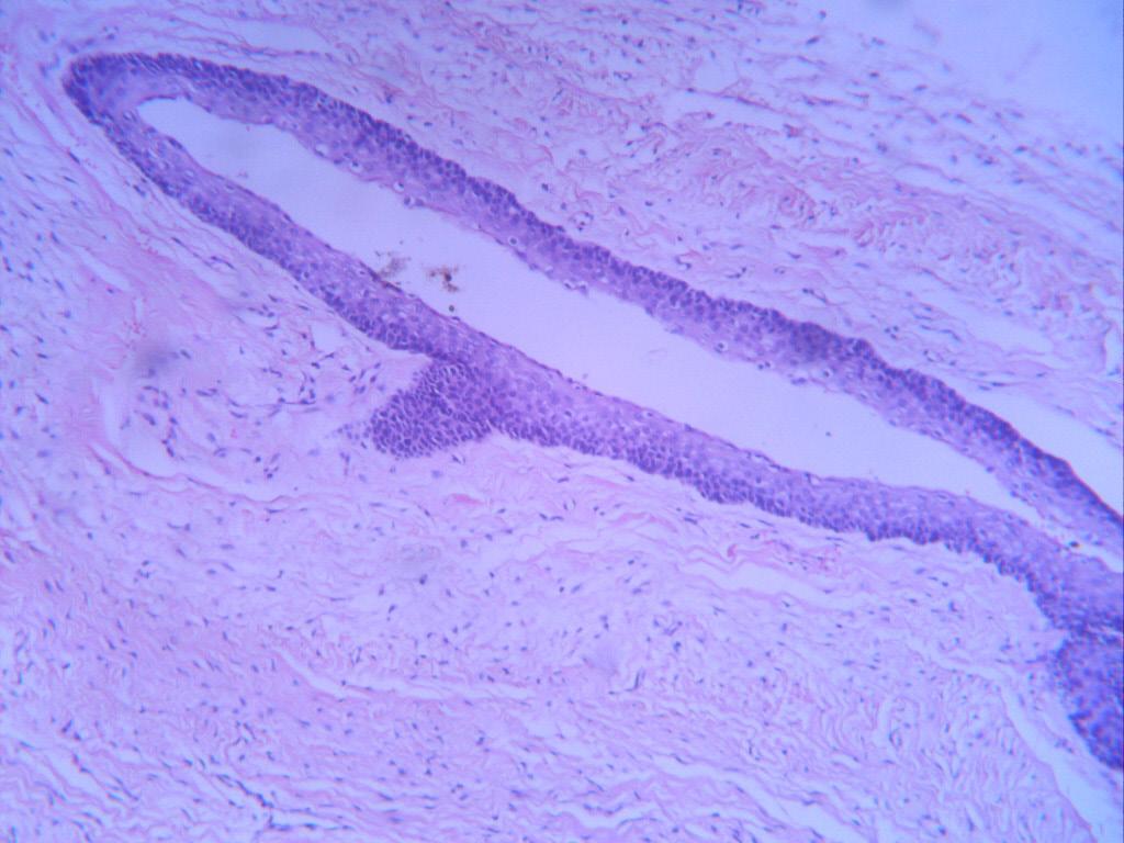 referred to as keratocystic odontogenic tumor (KCOT), is deemed an odontogenic cyst of developmental origin.