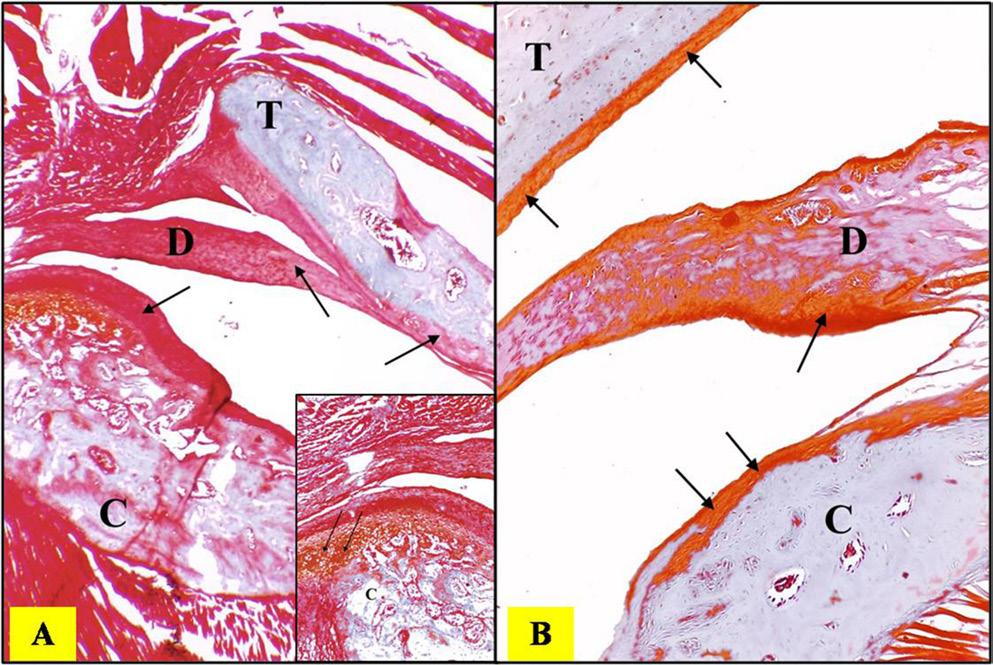 aligned with the direction of the condyle. Sagittal images of 1-millimeter thickness were used to assess various bony changes affecting the condyle (Fig. 1). Fig. 2.